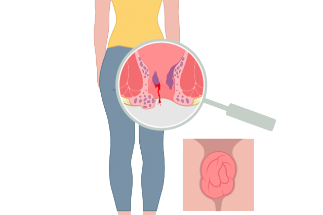 Best Doctor for Perianal Abscess Drainage in Hyderabad_1